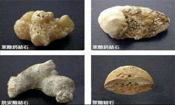 腎結石的種類(lèi)如何劃分